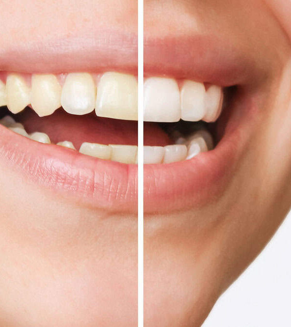 A close-up of a smile showing a side-by-side comparison of teeth before and after whitening, with the left side having yellowish teeth and the right side having whiter teeth.